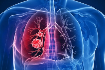 تنگی نفس و سرفه اولین علائم سرطان ریه هستند